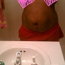 stretch marks everywhere