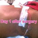 after surgery