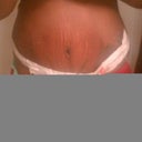6 days Post Op