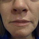 Dermabrasion In 46 Year Old Woman