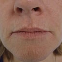 Dermabrasion In 46 Year Old Woman
