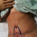 Day 2 in hosp. Swollen but beyond happy!  Stretch marks gone and I'm so flat!