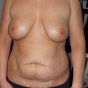 Front View the night before surgery