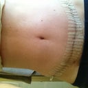 12/14 Getting ready to remove steri-strips.