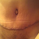 3 Weeks Post Op.  Front view of my Tummy.
