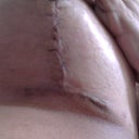 3 Week Post Op.  Left Breast