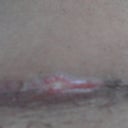 3 Weeks Post Op.  Raw incision.  Hopefully nothing.