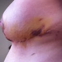 other side, more bruising