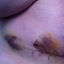 side bruise where drain was. Very black and blue!