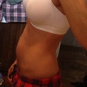 4 days PO, only swelling on left side (which isn't showing in this pic)