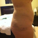 Side 10 days after surgery still some swelling but LOVING the results so far.