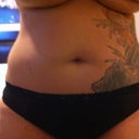 Front 10 days after surgery
