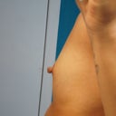 Before Right Breast