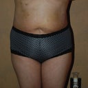 Day 3 Post Op Front