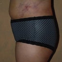 Day 3 Post Op Left