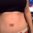 3 weeks post op