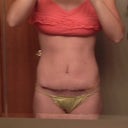 12 Days Postop