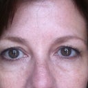 Before surgery. Notice how my lids lay right on my lashes?