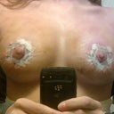3rd day post op. i think they look great! (considering) my left nipple is numb which worries me but im sure the feeling will come back with time.