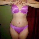 6 weeks, you can see my scar right above panty line (gotta get higher underwear).