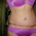 6 weeks, close up of scar