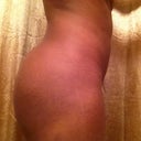 8wk post op