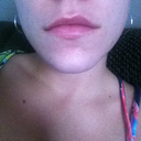 Over a month afterwards - Crooked smile, looks like its deflated on one side - not happy at all.