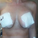 Day 2, front bare, with guaze