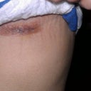 Scar. Very small