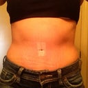 After Front 5 Weeks PO