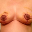 1 week 1 day post op