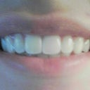 phone pic 5 days after zoom (2 cycles)