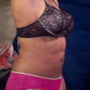 Left Side 11 Dec 2012! No exercising since I had the treatment in 2009!