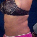 Right Side 1 Dec 2012! No exercising since I had the treatment in 2009