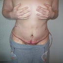Day four post op frontal view. Still cannot stand up straight.