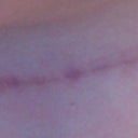 My longer scar is very long and still quite pink/red. Colour is darker in real life, this photo doesn't do it justice.