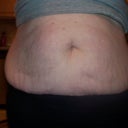 This is alot of loose skin