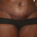 Seroma Belly
