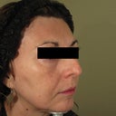 59 Yo Woman Treated With Laser Peel And PRP