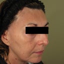59 Yo Woman Treated With Laser Peel And PRP