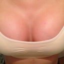 11 days post op