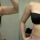 side by side comparison, 9 days post on picture 1, 26 days post op pic 2. note that the "square look" on the upper pole is gone!