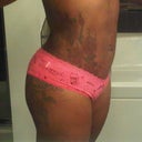 5 weeks post-op