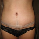 PO day 28.  I still wear steri-strip over the incision.