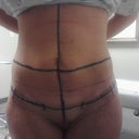 my tummy markings right before the surgery