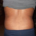 back view 5 days post tt