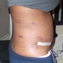 right side view 5days post tt, bruising from the liposuction