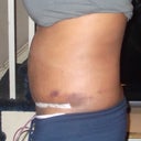 left side view 5days post tt, bruising from liposuction