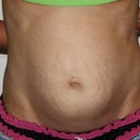 2 weeks before surgery