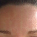 Forehead one hour after treatment